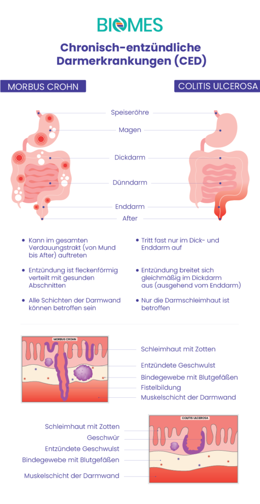 Unterschiede zwischen Morbus Crohn und Colitis Ulcerosa